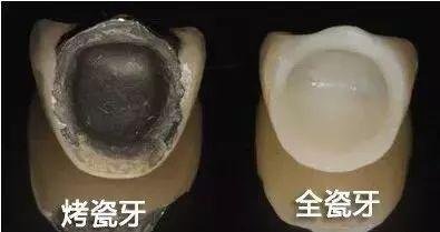 烤瓷牙全瓷牙.jpg